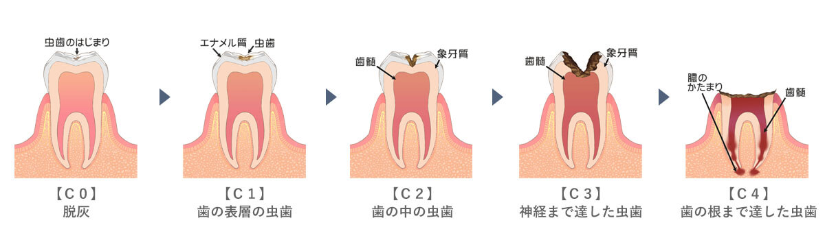 虫歯の進行