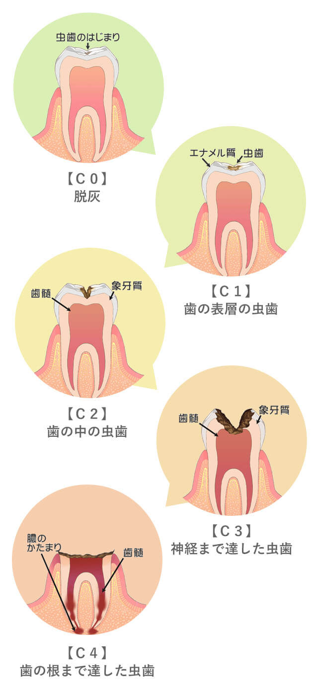 虫歯の進行