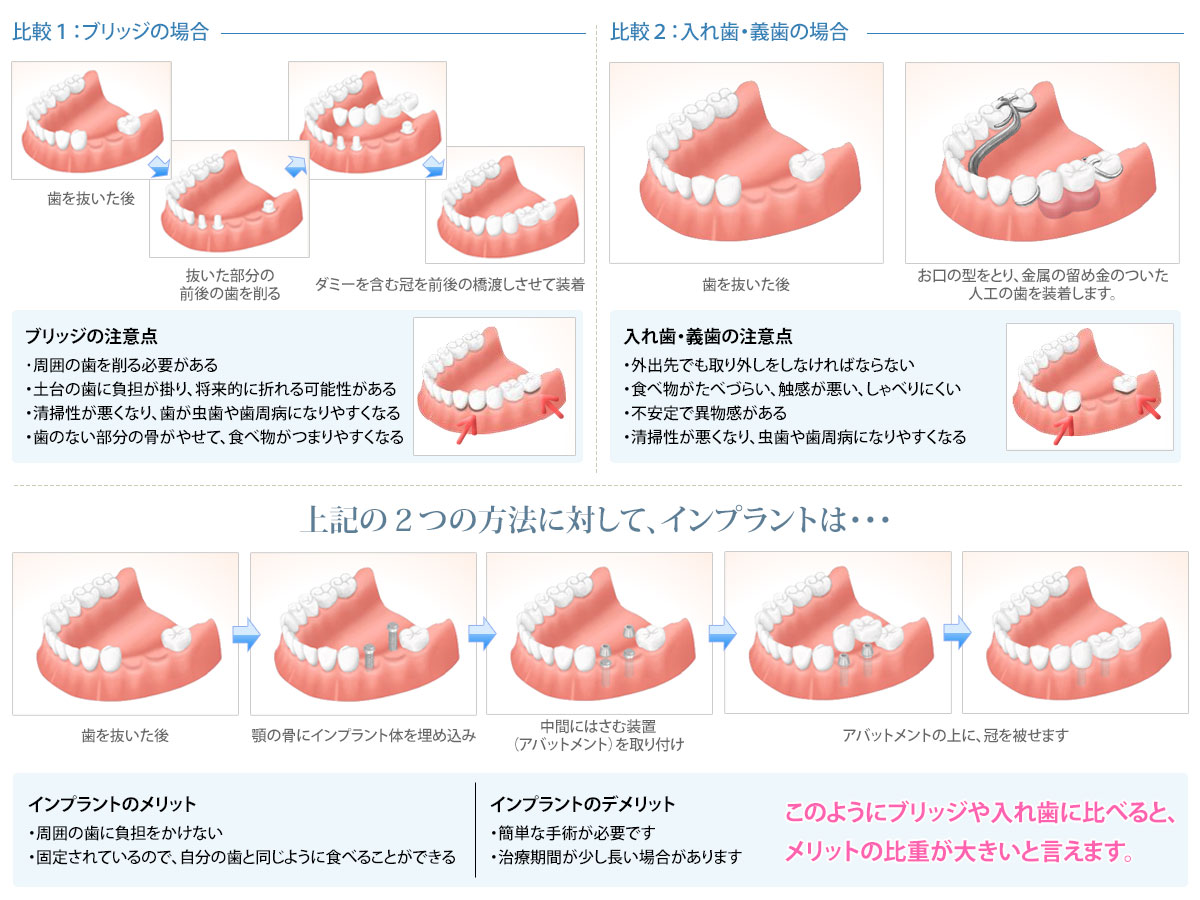 インプラント