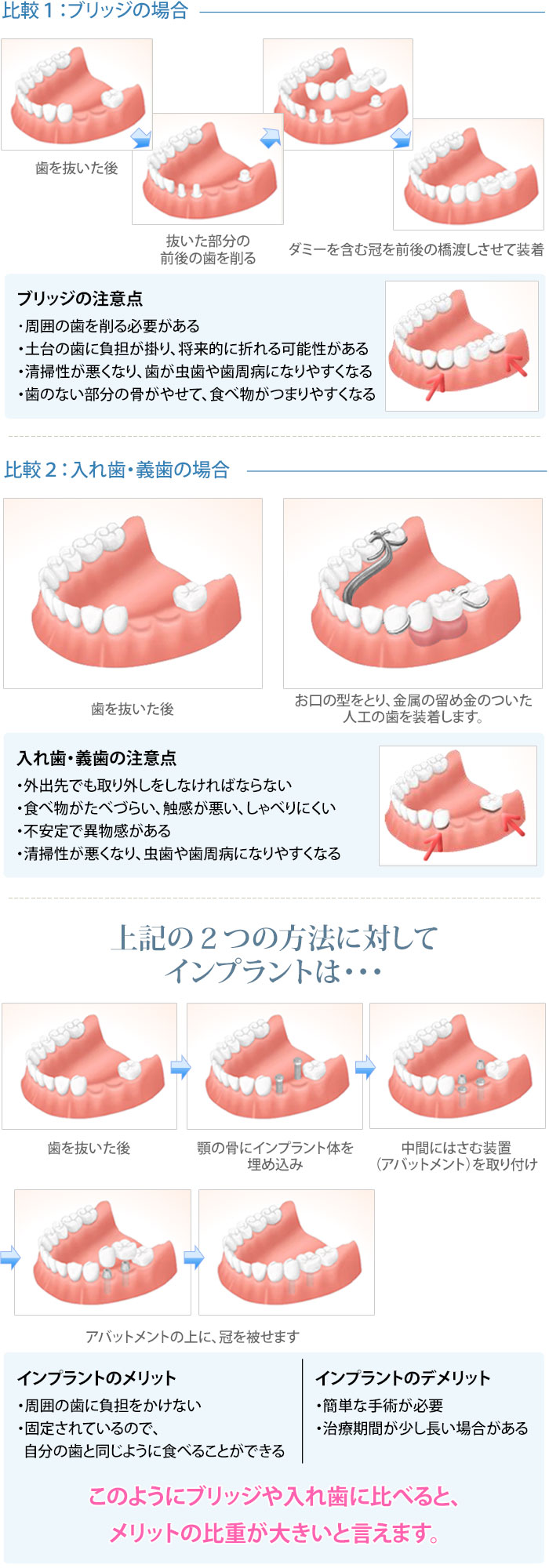 インプラント