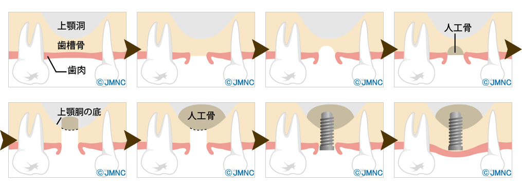 ソケットリフト法