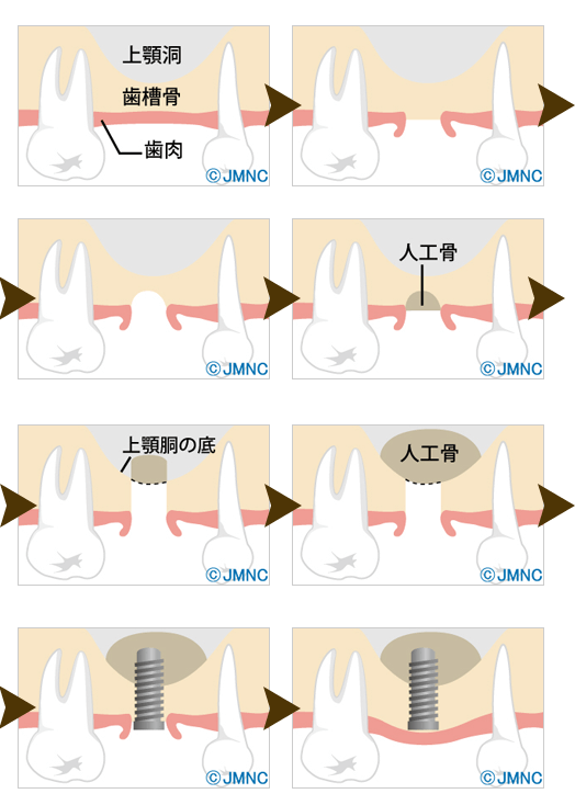 ソケットリフト法