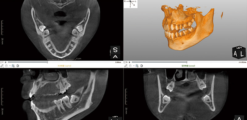 歯科用CT NAOMI-CTセファロ付き