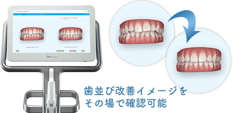 口腔内光学スキャナ iTero(アイテロ)