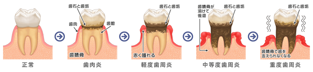 歯周病の進行