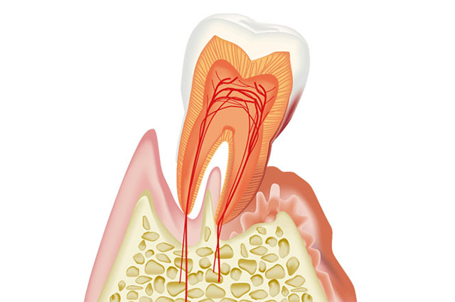 歯周病治療