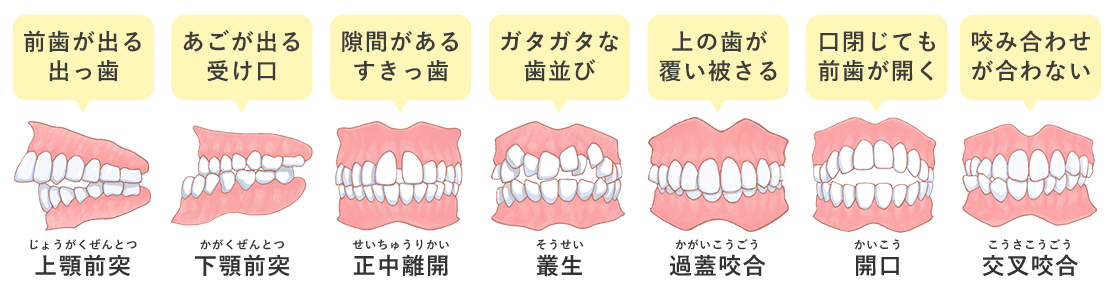 不正咬合